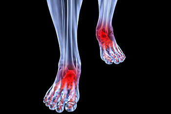 Arthritic foot and ankle care treatment in the Brooklyn, NY 11228 and Old Bridge, NJ 08857 area