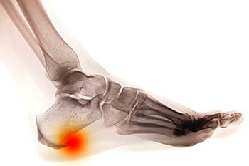 heel spur treatment in the Brooklyn, NY 11228 and Old Bridge, NJ 08857 area
