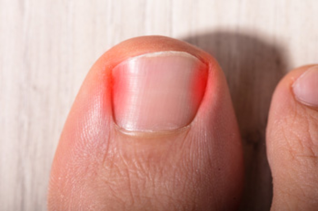 Ingrown Toenail Facts