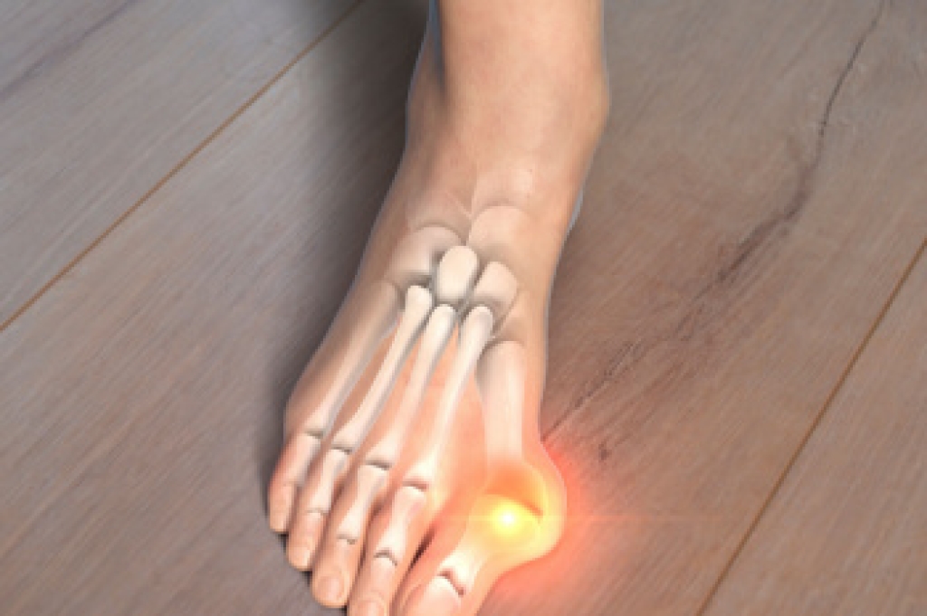 Comparing Bunions and Bunionettes