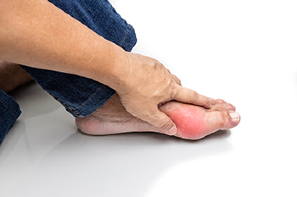 How Gout Is Diagnosed