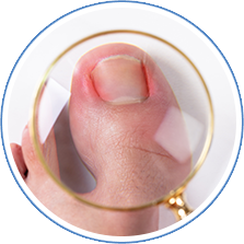 Ingrown Toenails