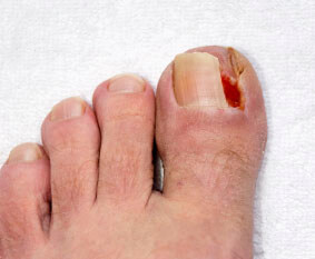 ingrown toenail in the Brooklyn, NY 11228 and Old Bridge, NJ 08857 area