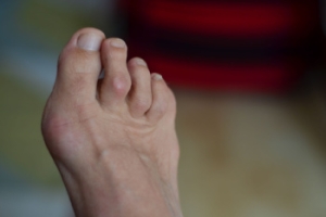 Hammertoe Deformity and Its Common Causes