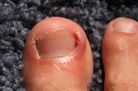 Foot Wounds From Ingrown Toenails